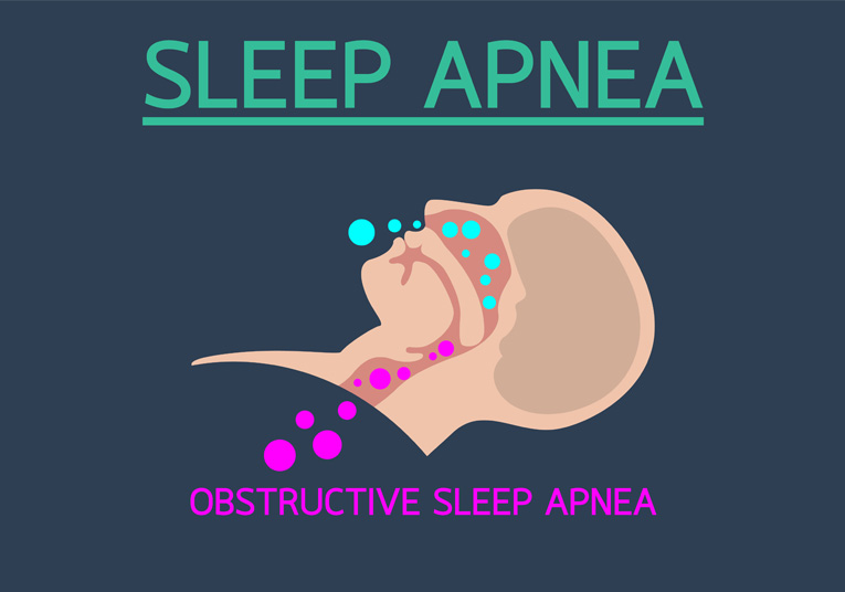 Sleep Apnea – Pulmonary Practice